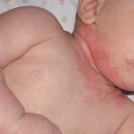 alergi pada bayi