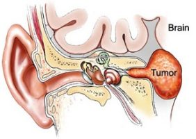 Acoustic Neuroma