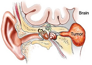 Acoustic Neuroma