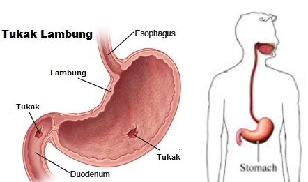 penyakit tukak lambung