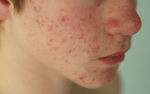 jerawat meradang